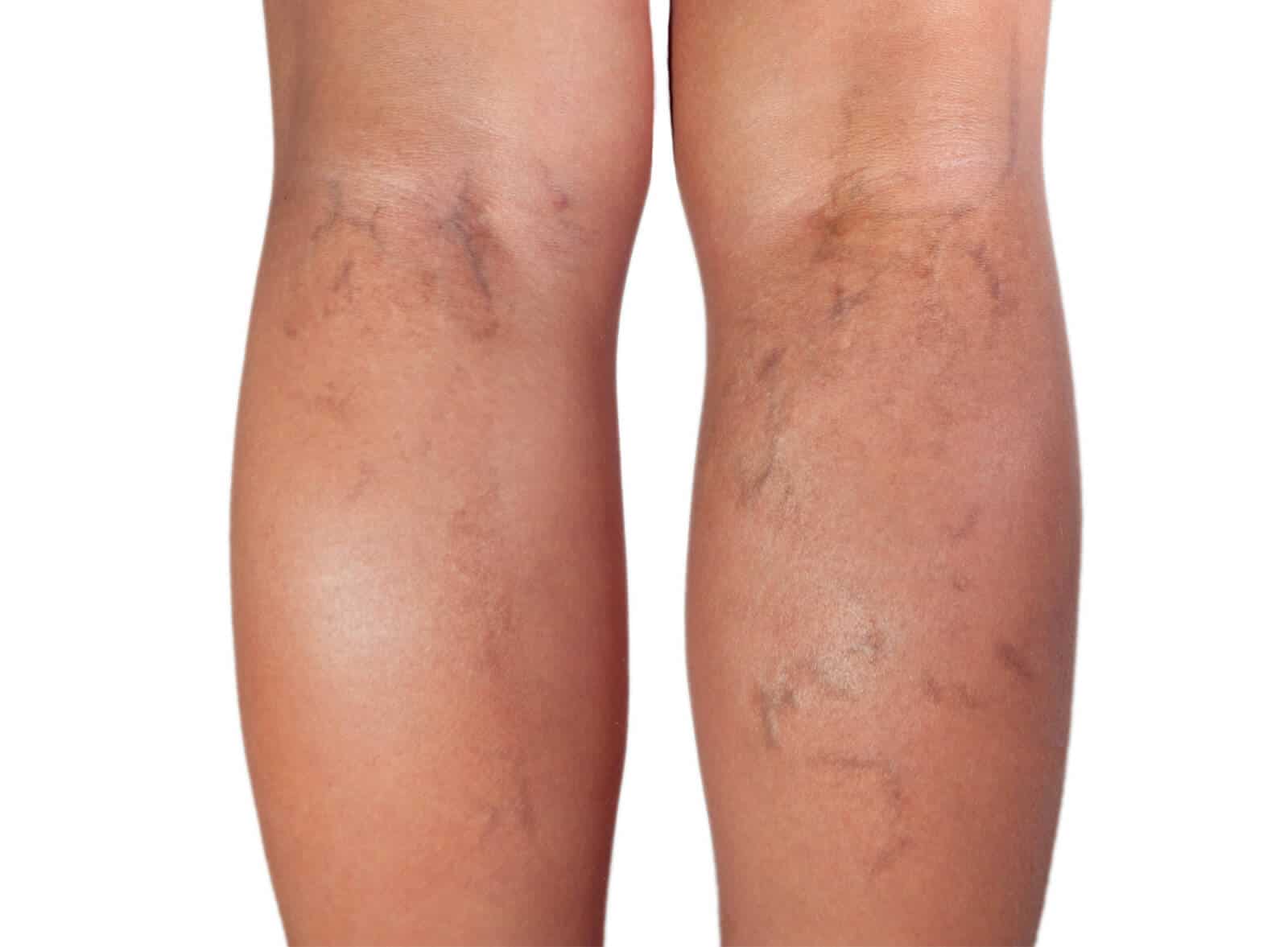 varicose-vein-treatment-west-palm-before (1)