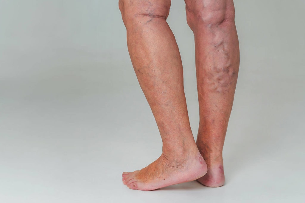 What Does Venous Stasis Mean In Medical Terms